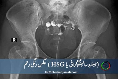 عکس رنگی رحم (HSG) 
